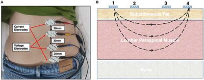 Electrical Properties of Lumbar Paraspinal Muscles in Young Adults With and Without Chronic Low Back Pain Based on Electrical Impedance Myography: A Cross-Sectional Study